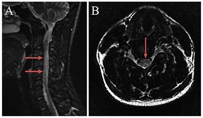 Case report: Subacute combined degeneration of the spinal cord due to nitrous oxide abuse